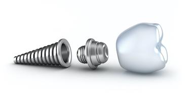 image of a dental implant with crown