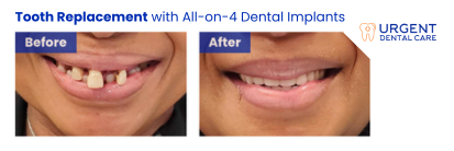 before and after all on 4 dental implants | dentist milwaukee