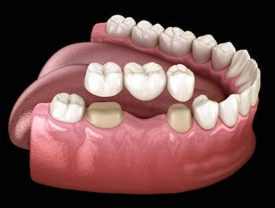 dental bridge west allis