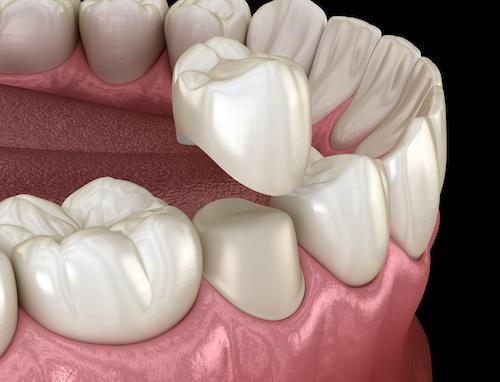 dental crown milwaukee