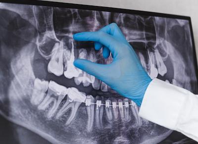 root canal west allis | dentist with dental x-ray