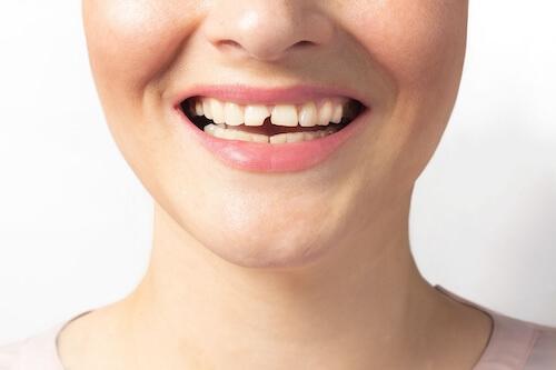 walk-in dentist milwaukee | woman with chipped tooth
