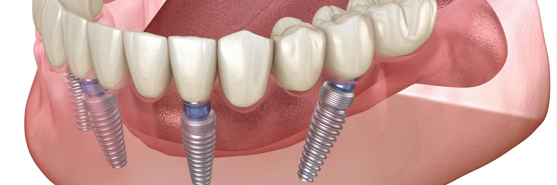 all on 4 dental implants west allis