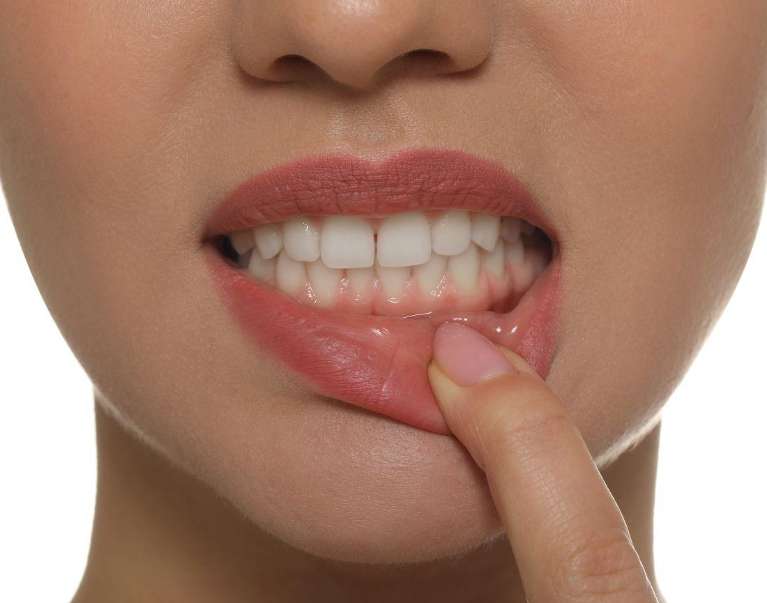 woman needing gum disease treatment in West Allis