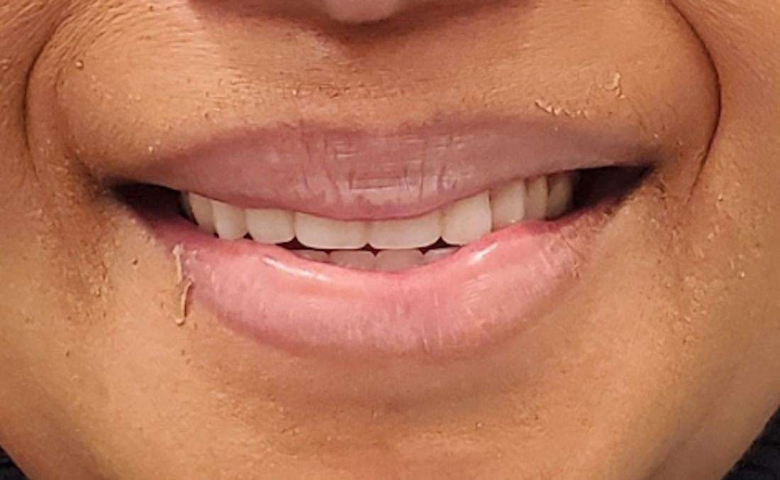 all-on-4 implants after photo