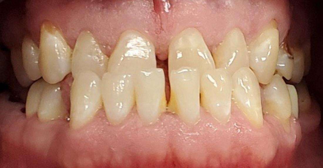 all on 4 dental implants before photo