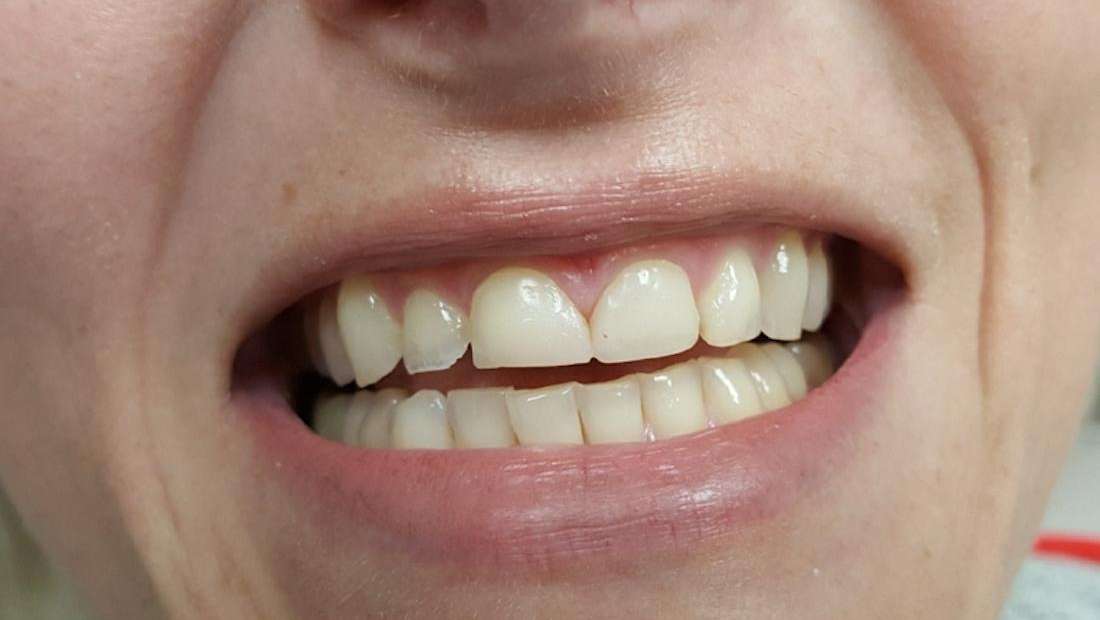 patient's smile before cosmetic dentistry