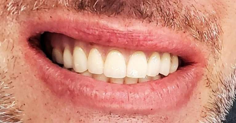 All-on-4-Dental-Implants-After-Image