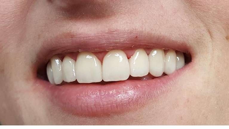 patient's smile after cosmetic dentistry treatments