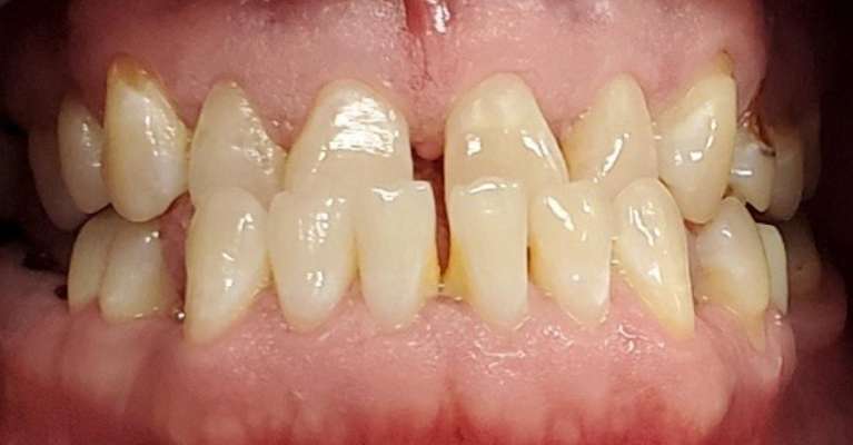 All-on-4-Dental-Implants-Before-Image