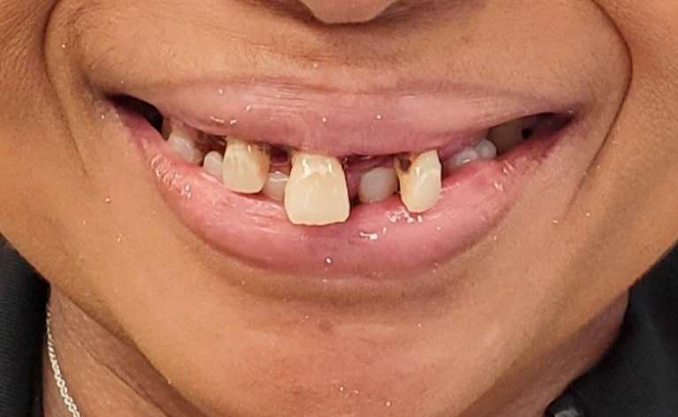All-on-4-Implants-Before-Image